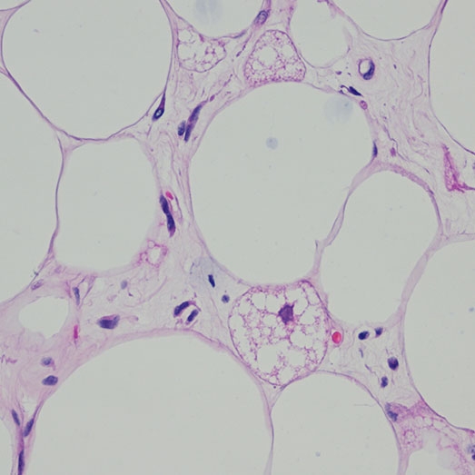 LIPOSSARCOMA DESDIFERENCIADO