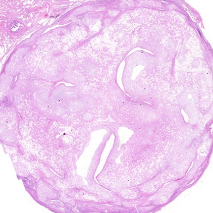 HAMARTOMA PULMONAR