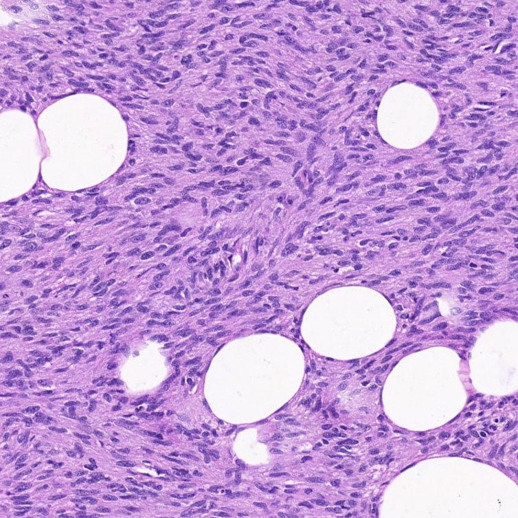 FIBROSSARCOMA